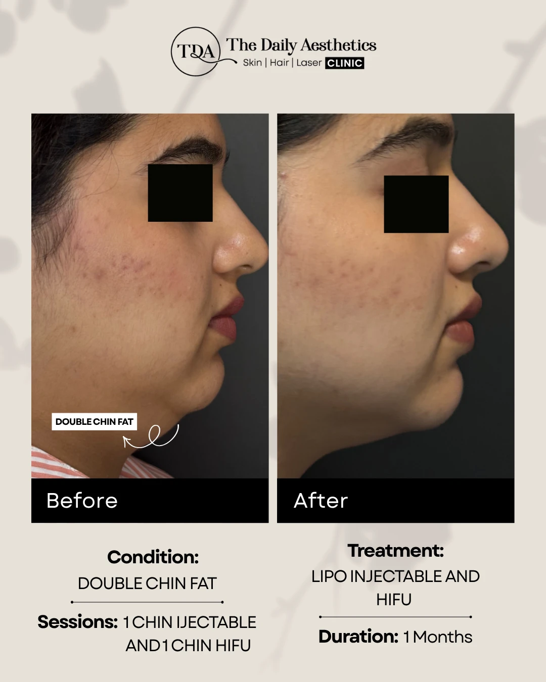 Double Chin Fat (Lipo Injectable and HIFU Treatment)