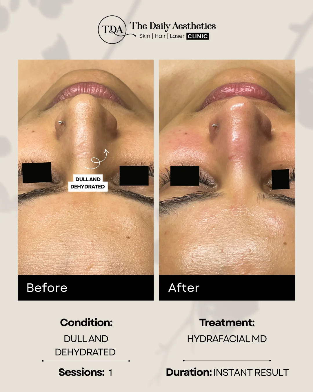 Dull And Dehydrated (Hydrafacial MD Treatment) 2