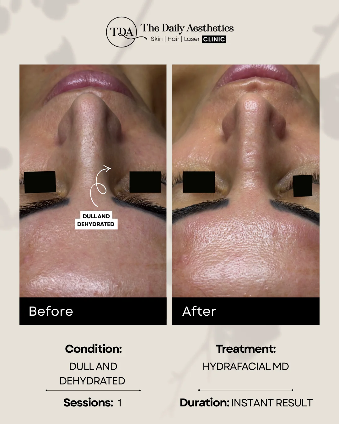 Dull And Dehydrated (Hydrafacial MD Treatment) 3
