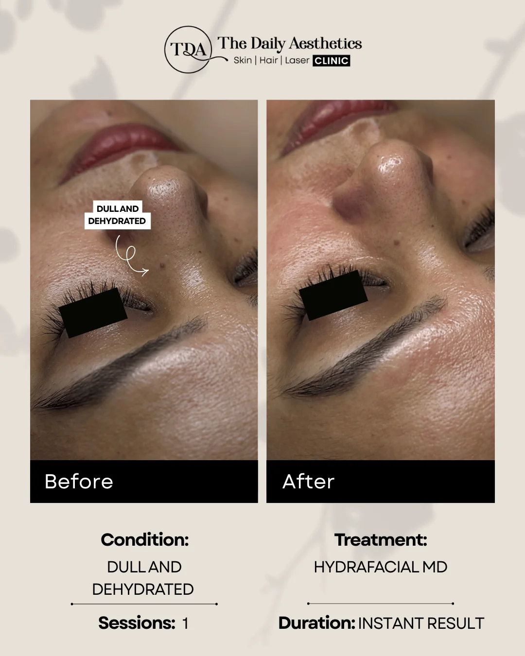Dull And Dehydrated (Hydrafacial MD Treatment)
