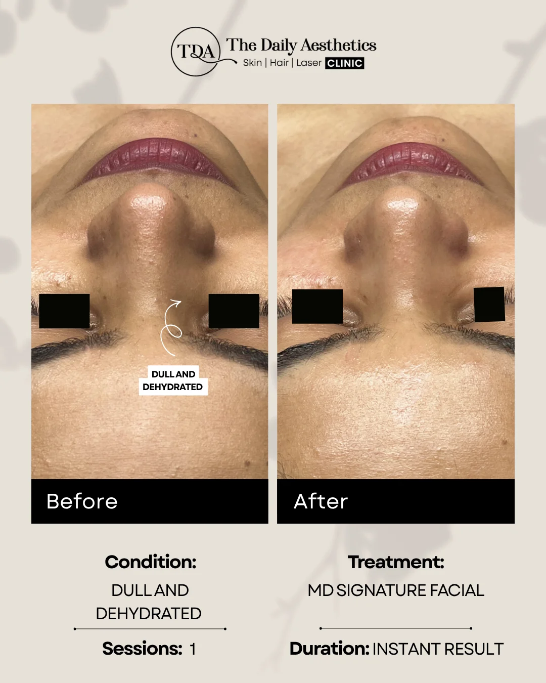 Dull And Dehydrated (MD Signature Facial Treatment)