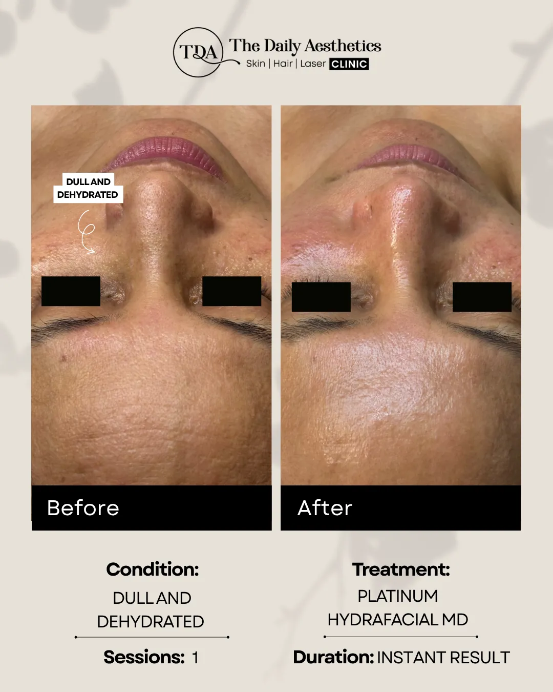Dull And Dehydrated (Platinum Hydrafacial MD Treatment)