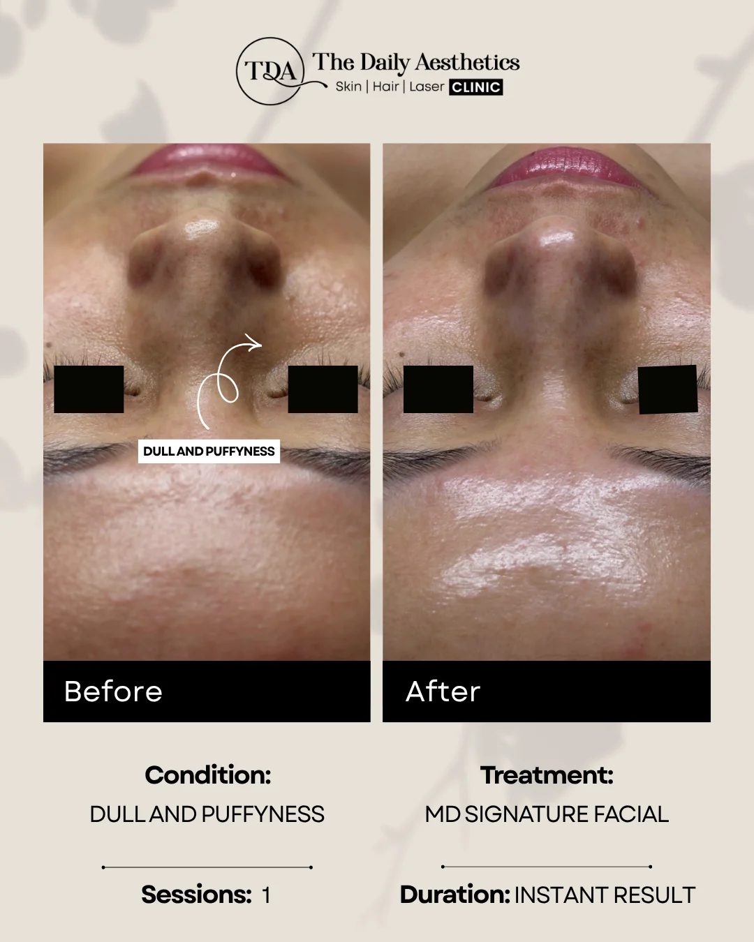 Dull And Puffyness (MD Signature Facial Treatment)