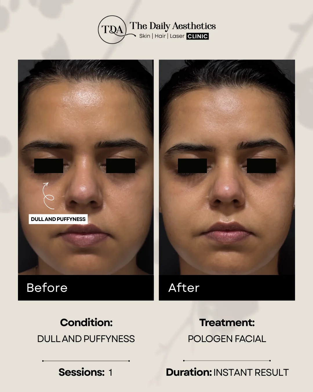 Dull And Puffyness (Pologen Facial Treatment)