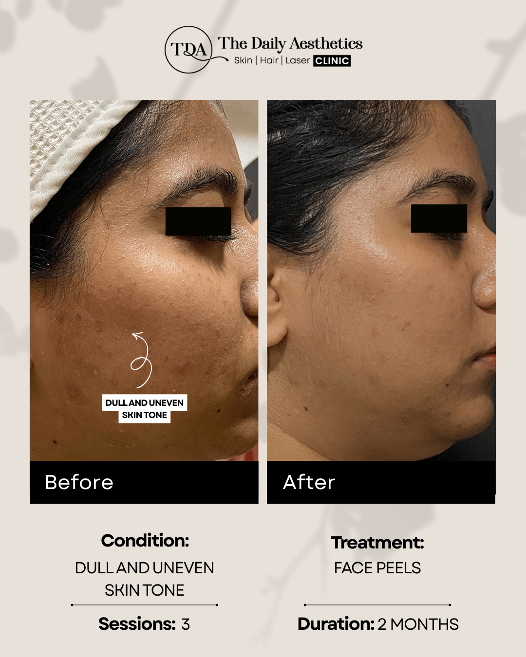 Dull And Uneven Skin Tone (Face Peels Treatment)