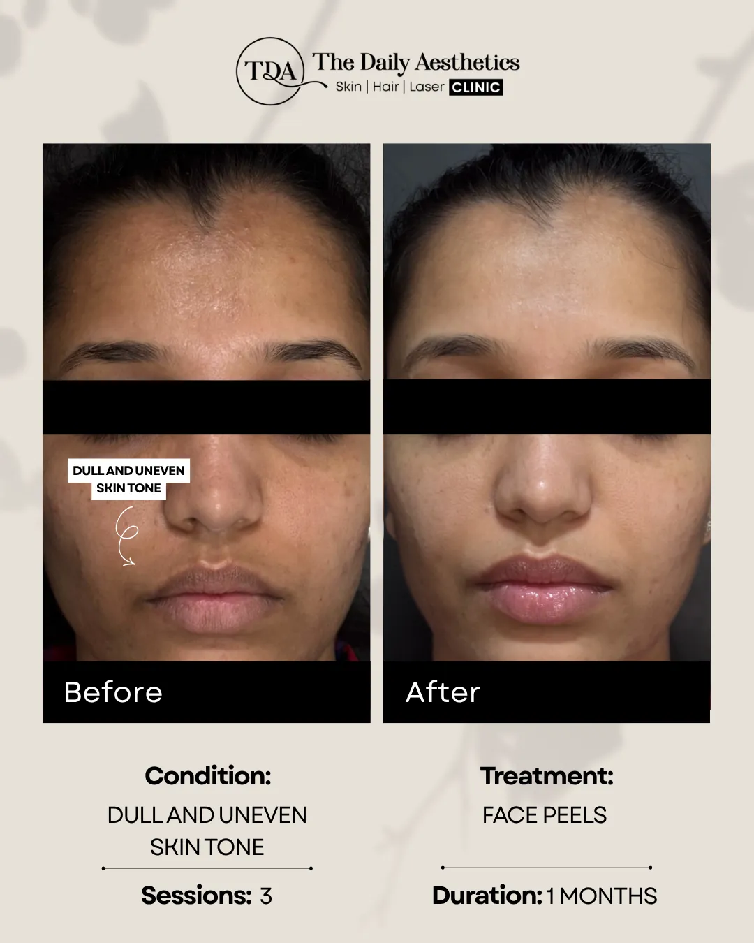Dull And Uneven Skin Tone (Face Peels Treatment)