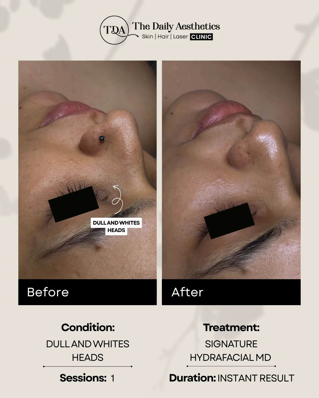Dull And Whites Heads (Signature Hydrafacial MD Treatment)