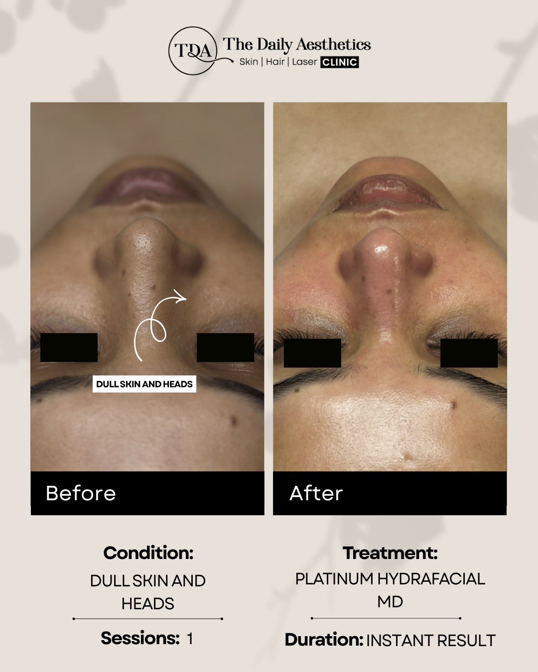 Dull Skin And Heads (Platinum Hydrafacial MD Treatment) (2)