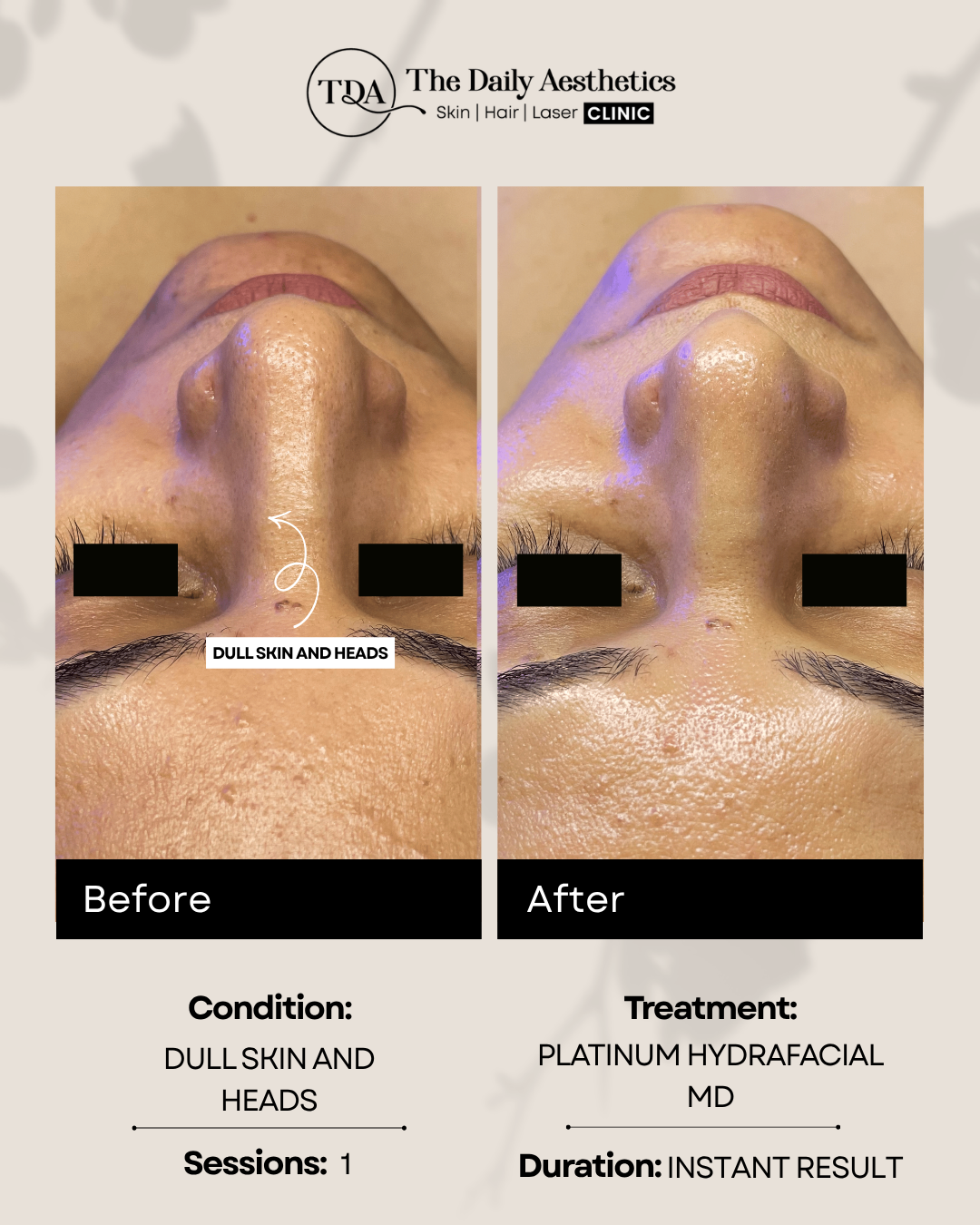 Dull Skin And Heads (Platinum Hydrafacial MD Treatment)