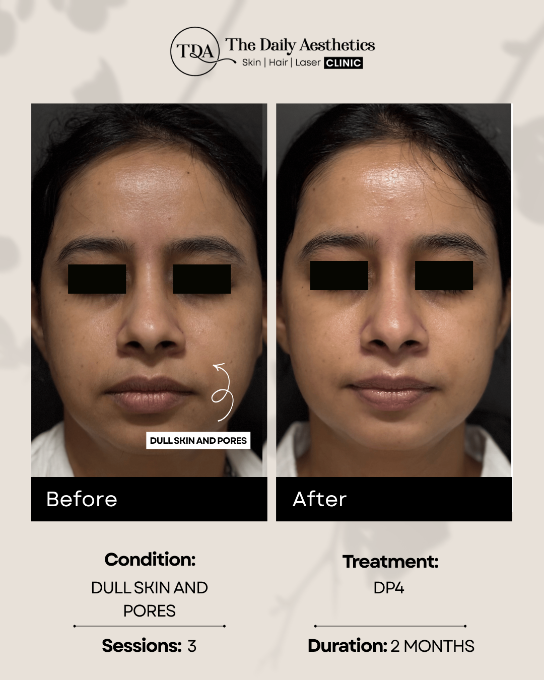 Dull Skin And Pores (DP4 Treatment)