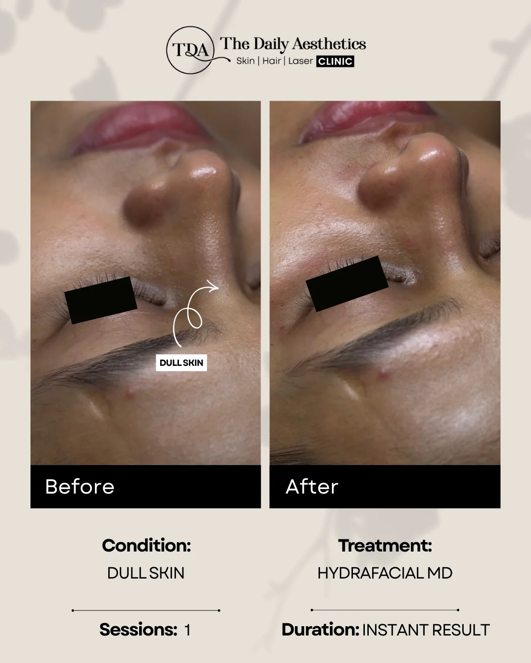 Dull Skin (Hydrafacial MD Treatment)