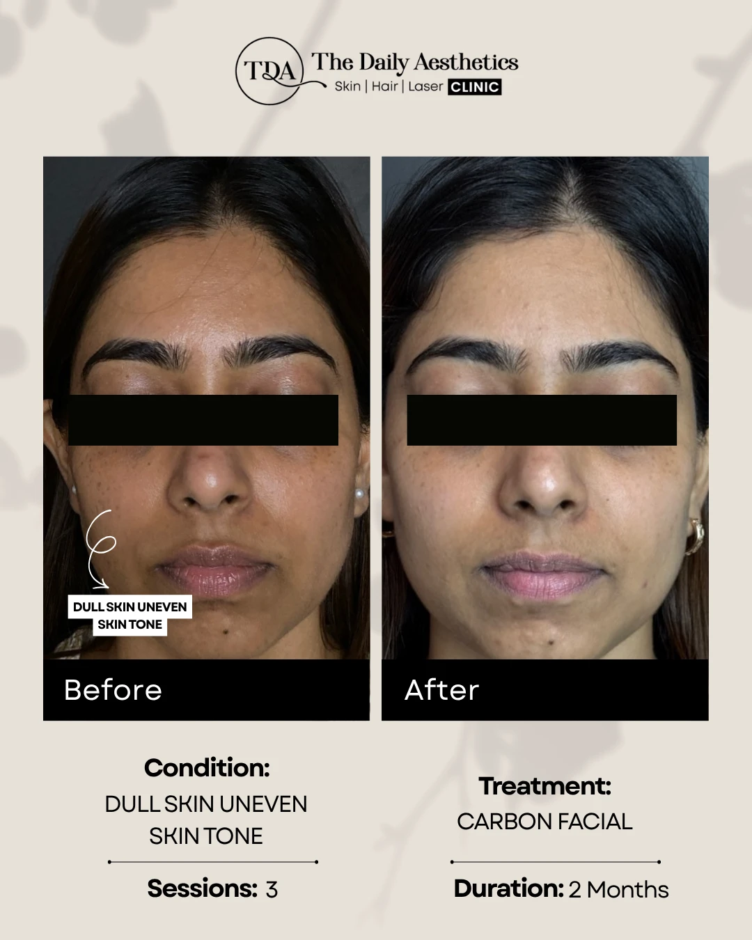 Dull Skin Uneven Skintone (Carbon Facial Treatment)