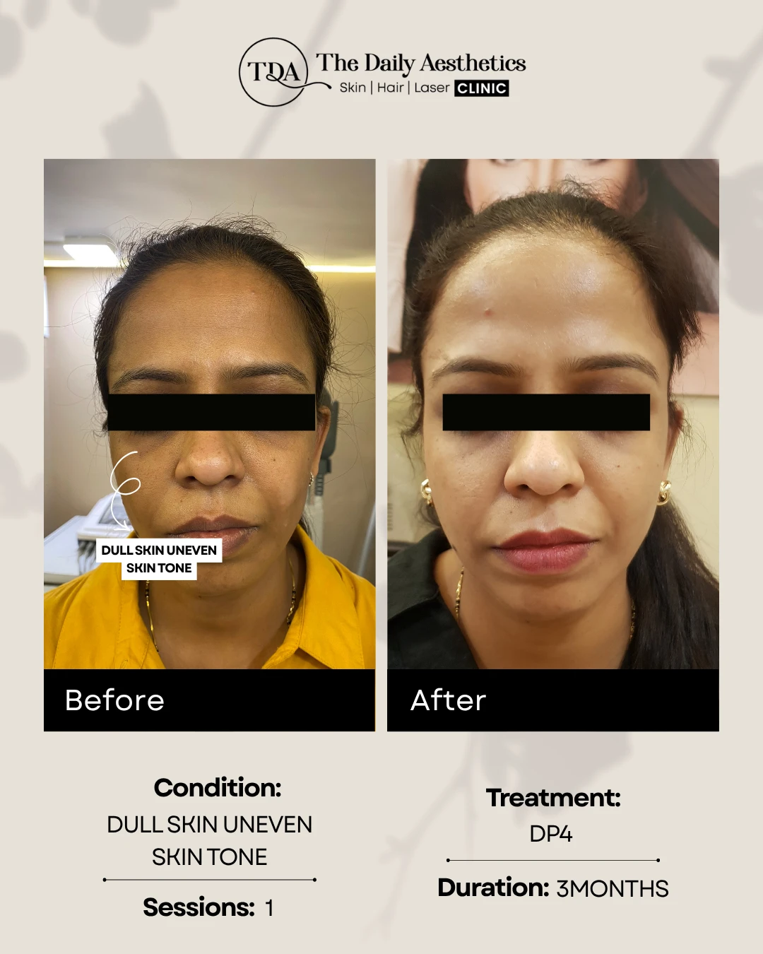 Dull Skin Uneven Skintone (DP4)