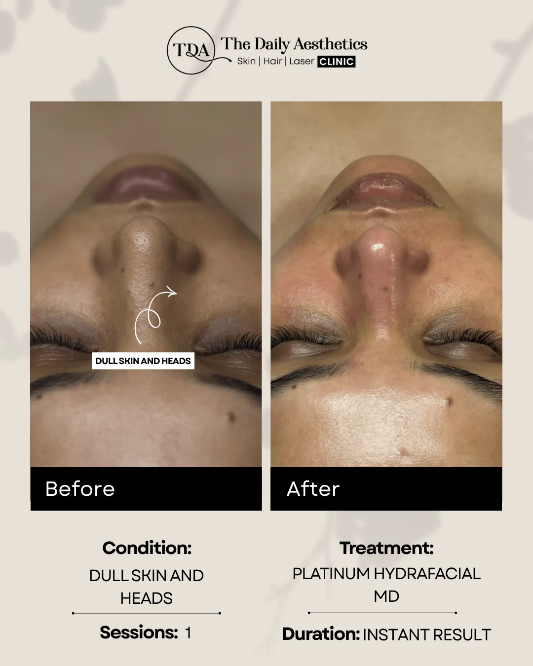 Dull Skin and Heads(Platinum Hydrafacial MD) Instant Result