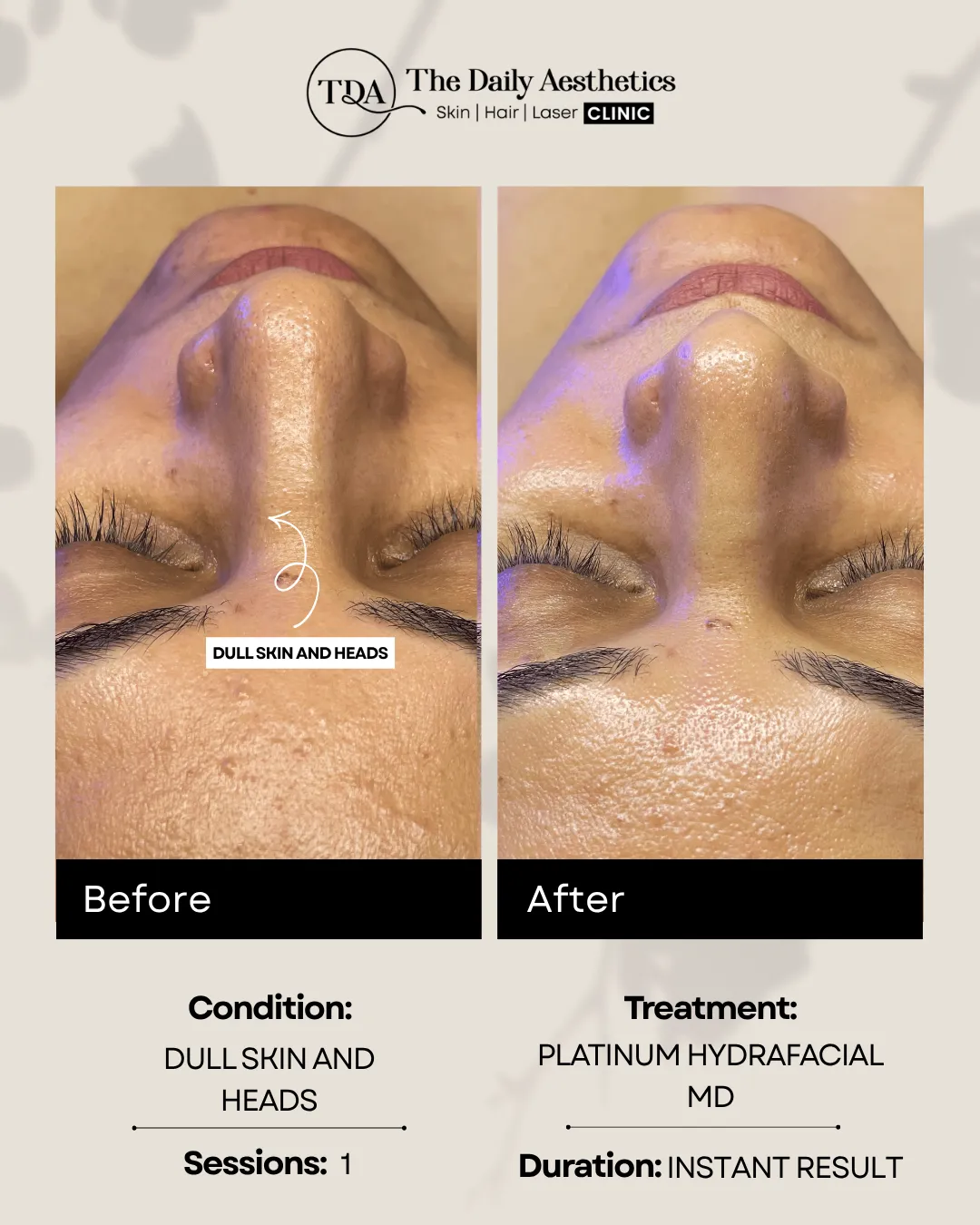 Dull Skin and Heads(Platinum Hydrafacial MD)