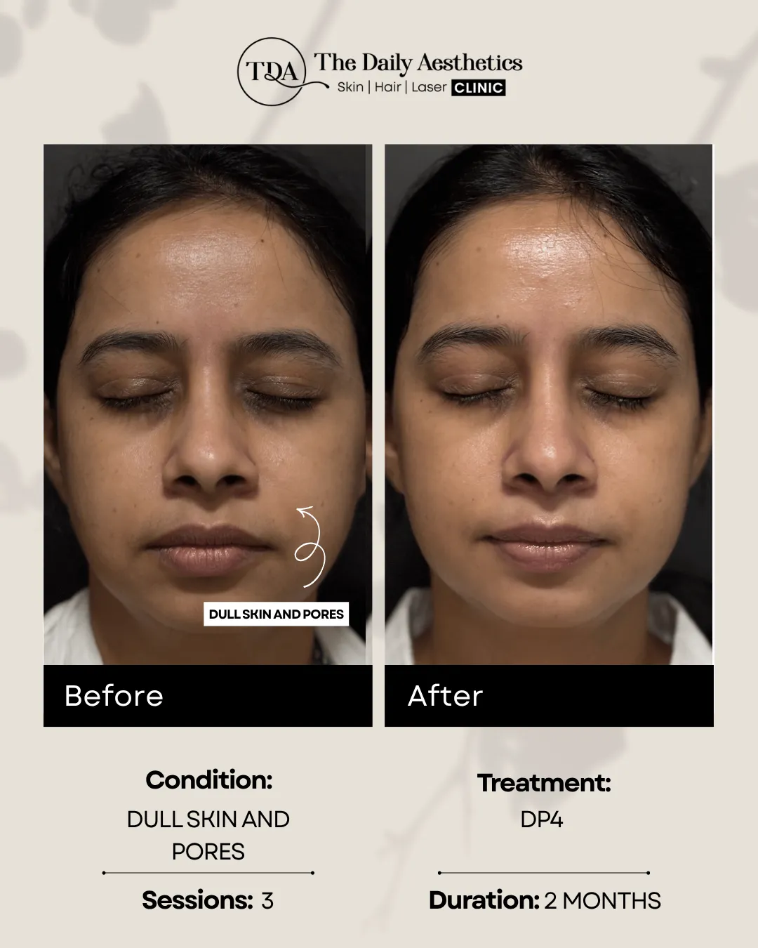 Dull Skin and Pores (DP4)