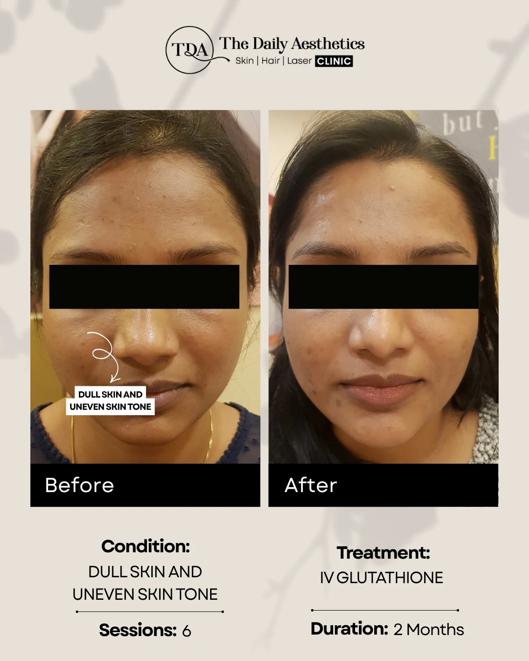 Dull Skin and Uneven Skintone (IV Glutathione) (2)