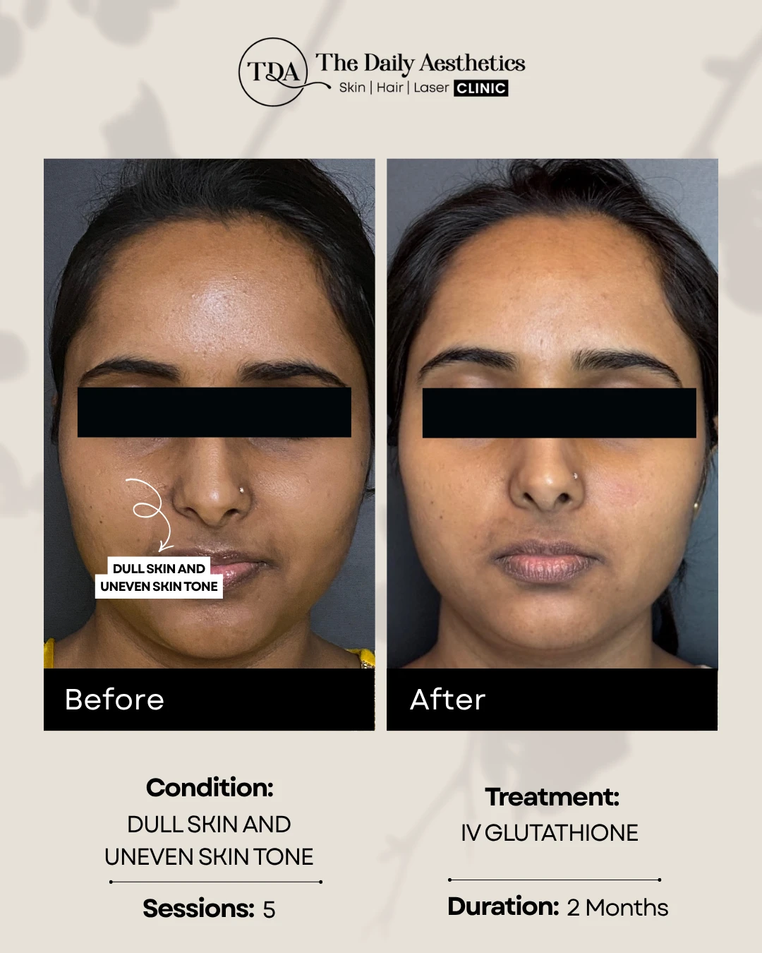 Dull Skin and Uneven Skintone (IV Glutathione)