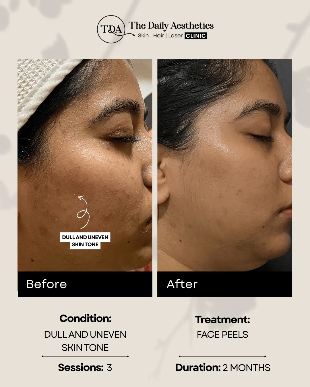 Dull and Uneven Skintone (Face Peels)