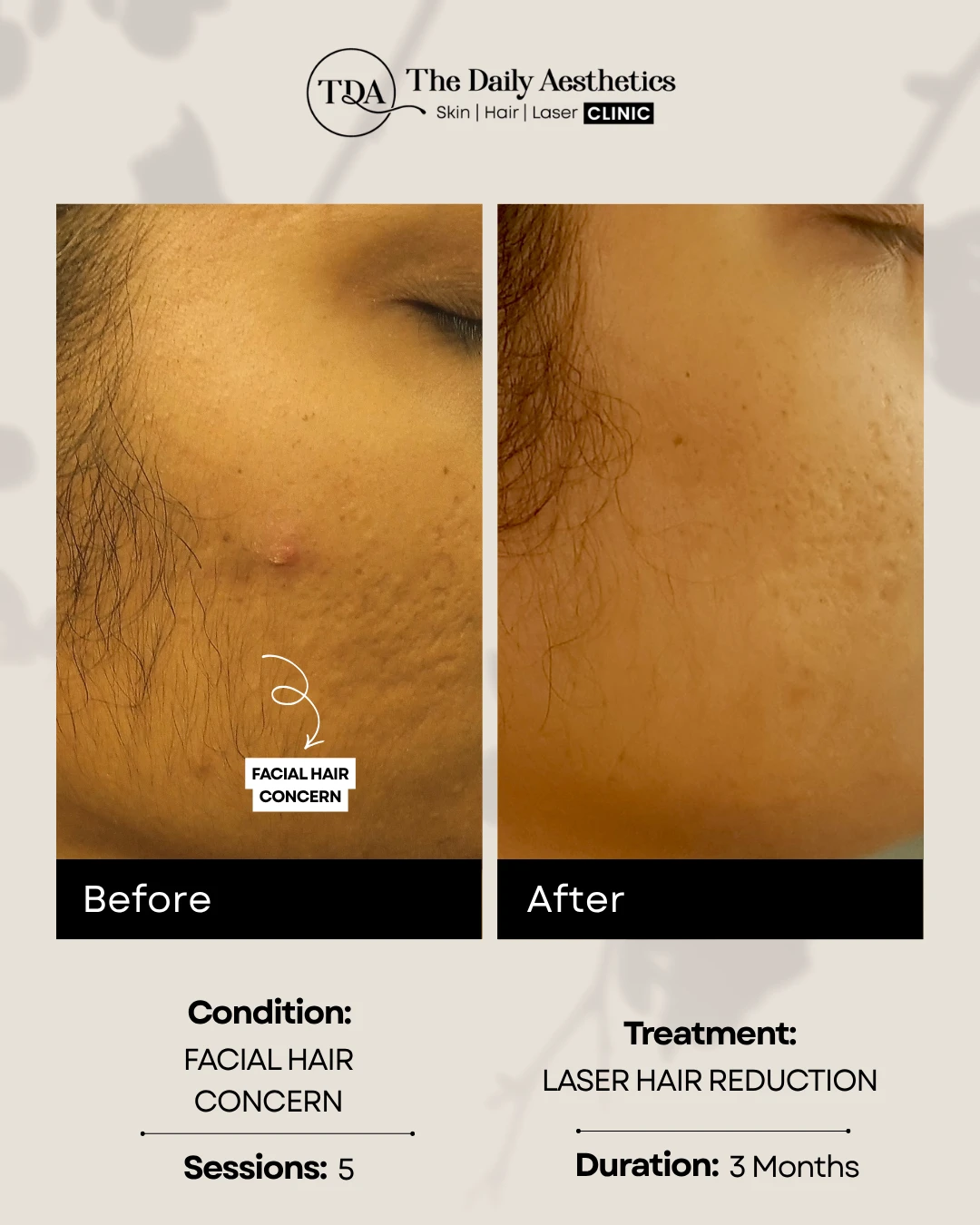 Face Hair Concern (Laser Hair Reduction Treatment)