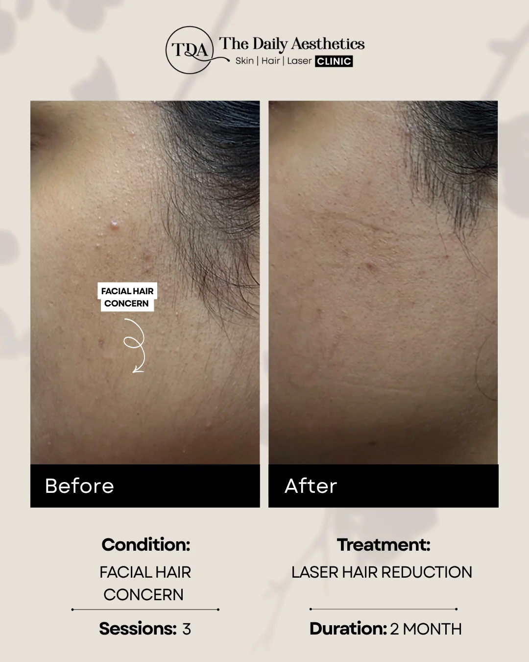 Facial Hair Cercern (Laser Hair Reduction Treatment)