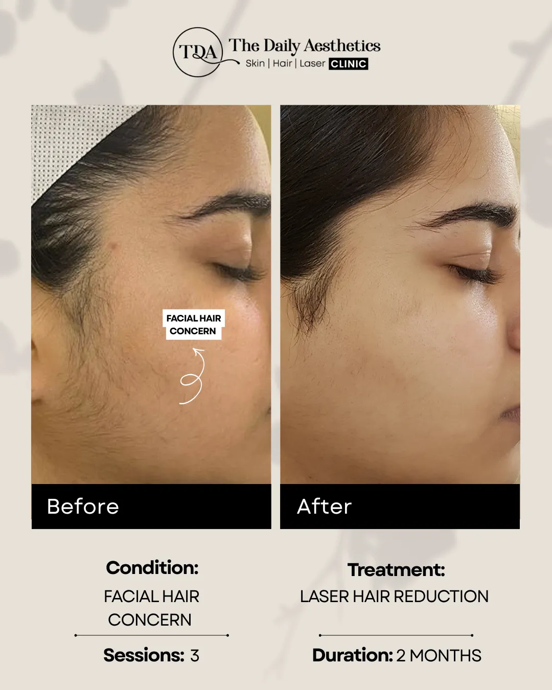 Facial Hair Concern (Laser Hair Reduction)