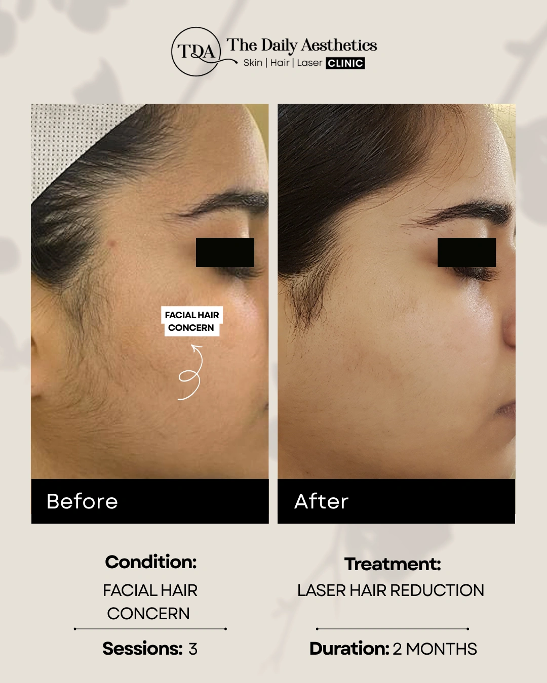 Facial Hair Concern (Laser Hair Reduction Treatment)