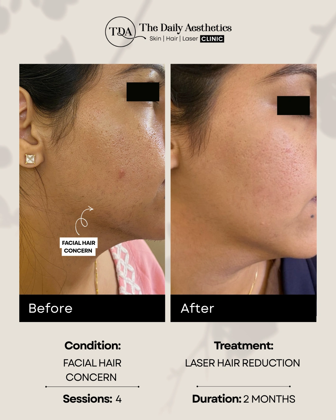 Facial Hair Concern (Laser Hair Reduction Treatment)