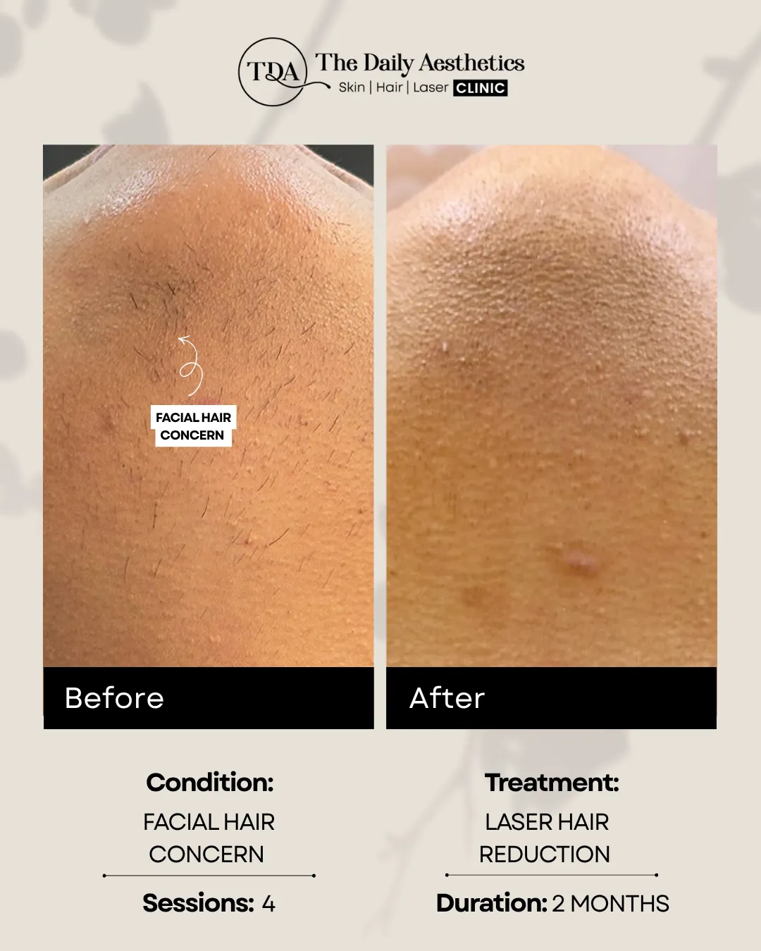 Facial Hair Concern (Laser Hair Reduction Treatment) (3)