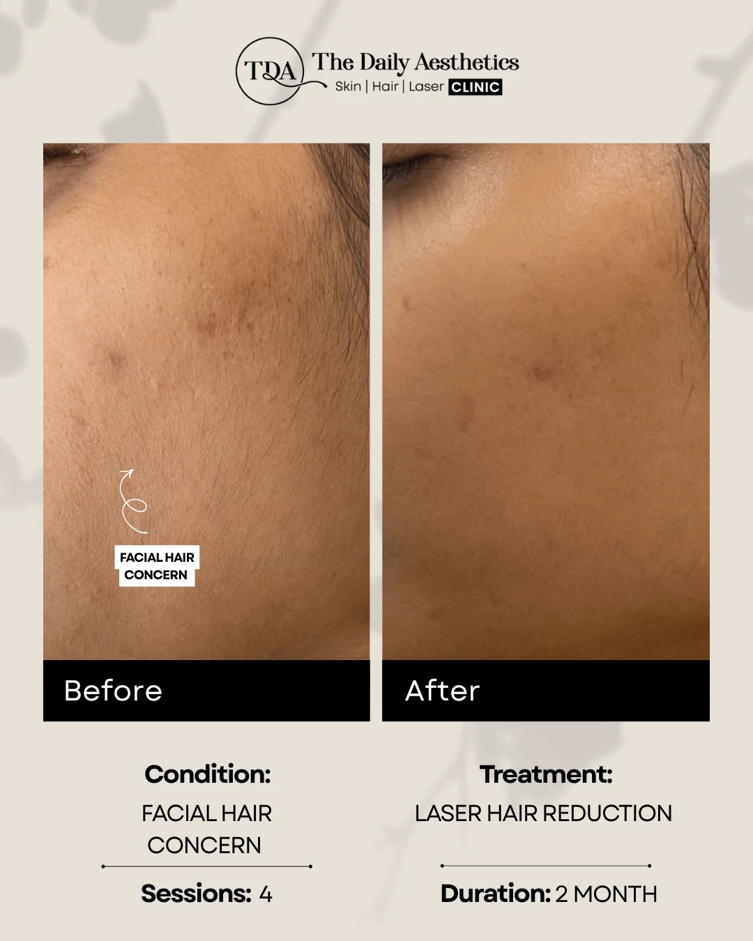 Facial Hair Concern (Laser Hair Reduction Treatment)