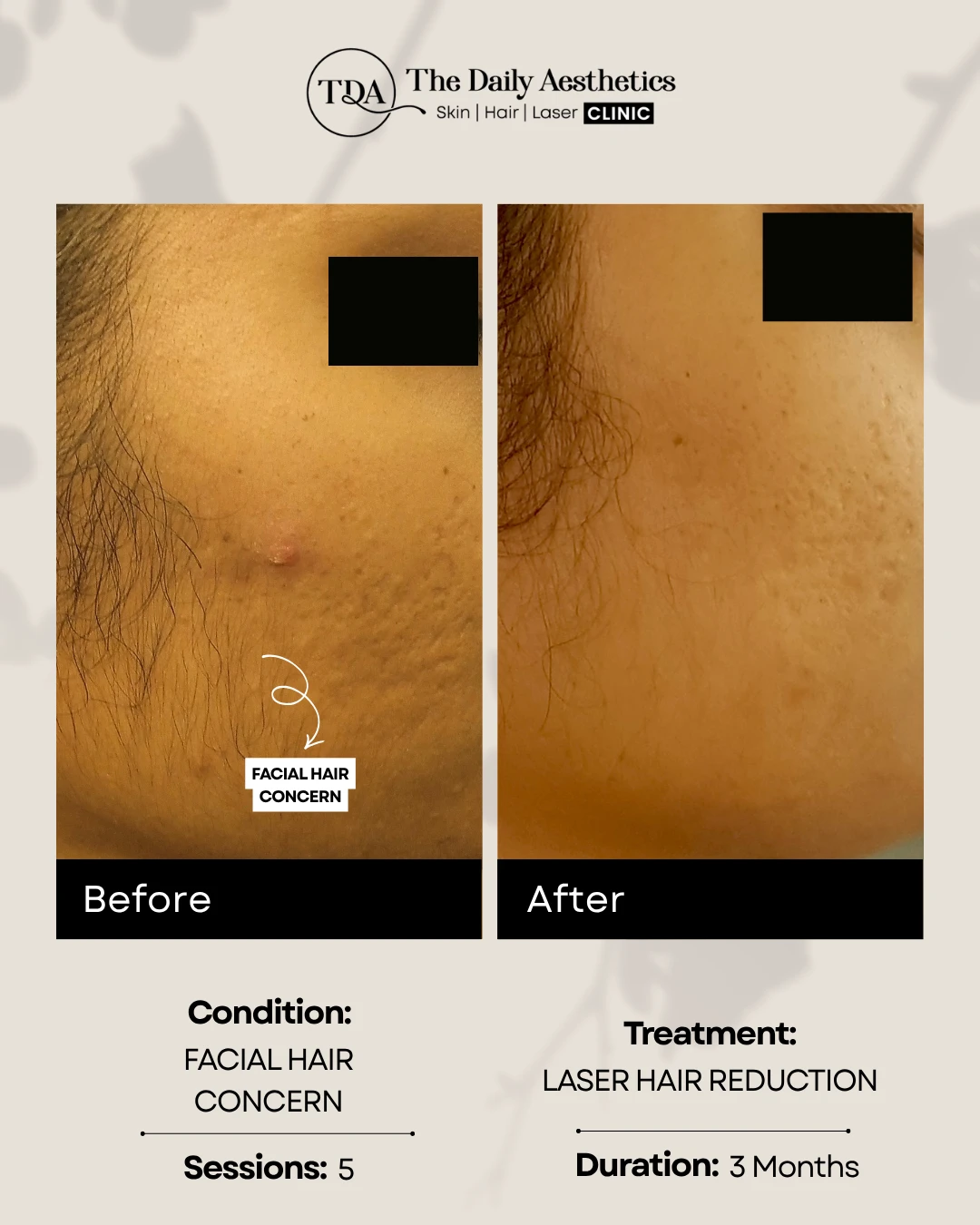 Facial Hair Concern (Laser Hair Reduction)