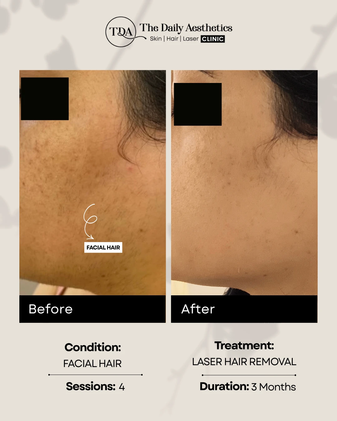 Facial Hair (Laser Hair Removal Treatment)