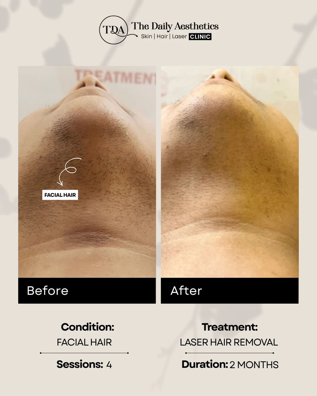 Facial Hair (Laser Hair Removal)