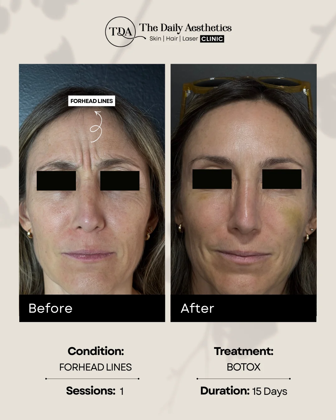 Forhead Lines (Botox)