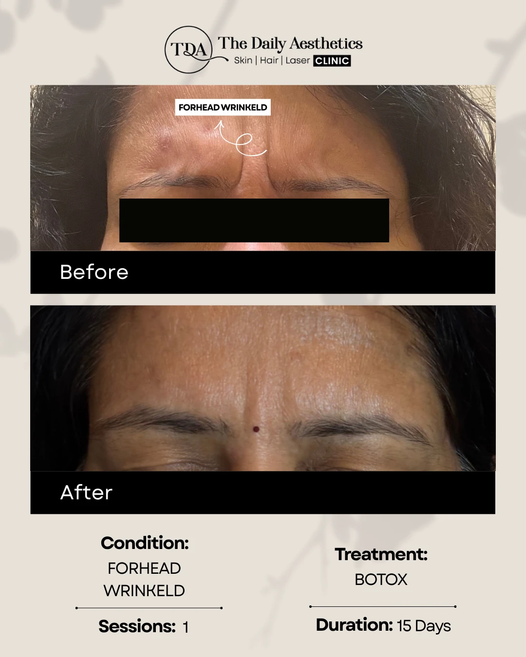 Forhead Wrinkled (Botox Treatment)
