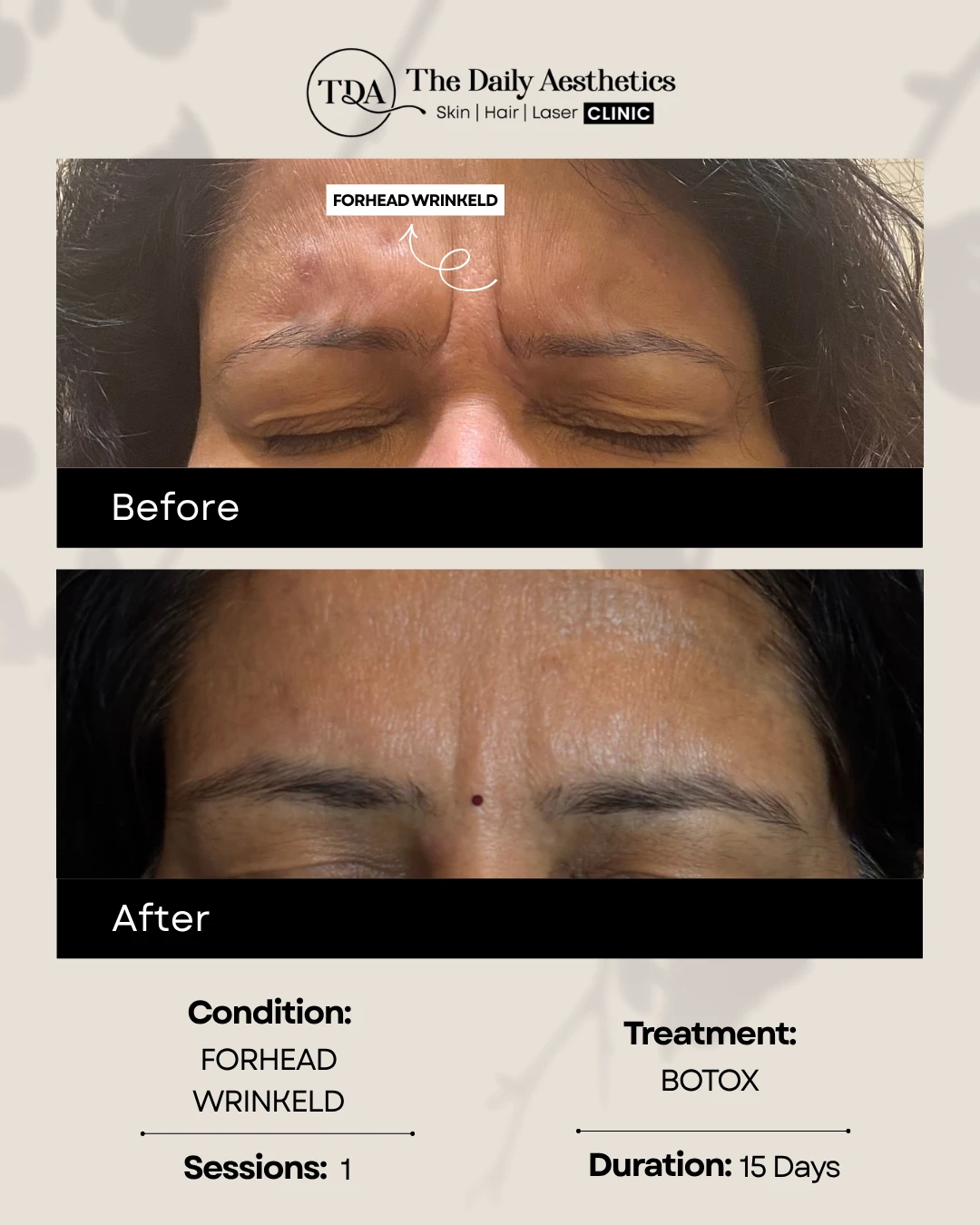 Forhead Wrinkled (Botox Treatment) (2)