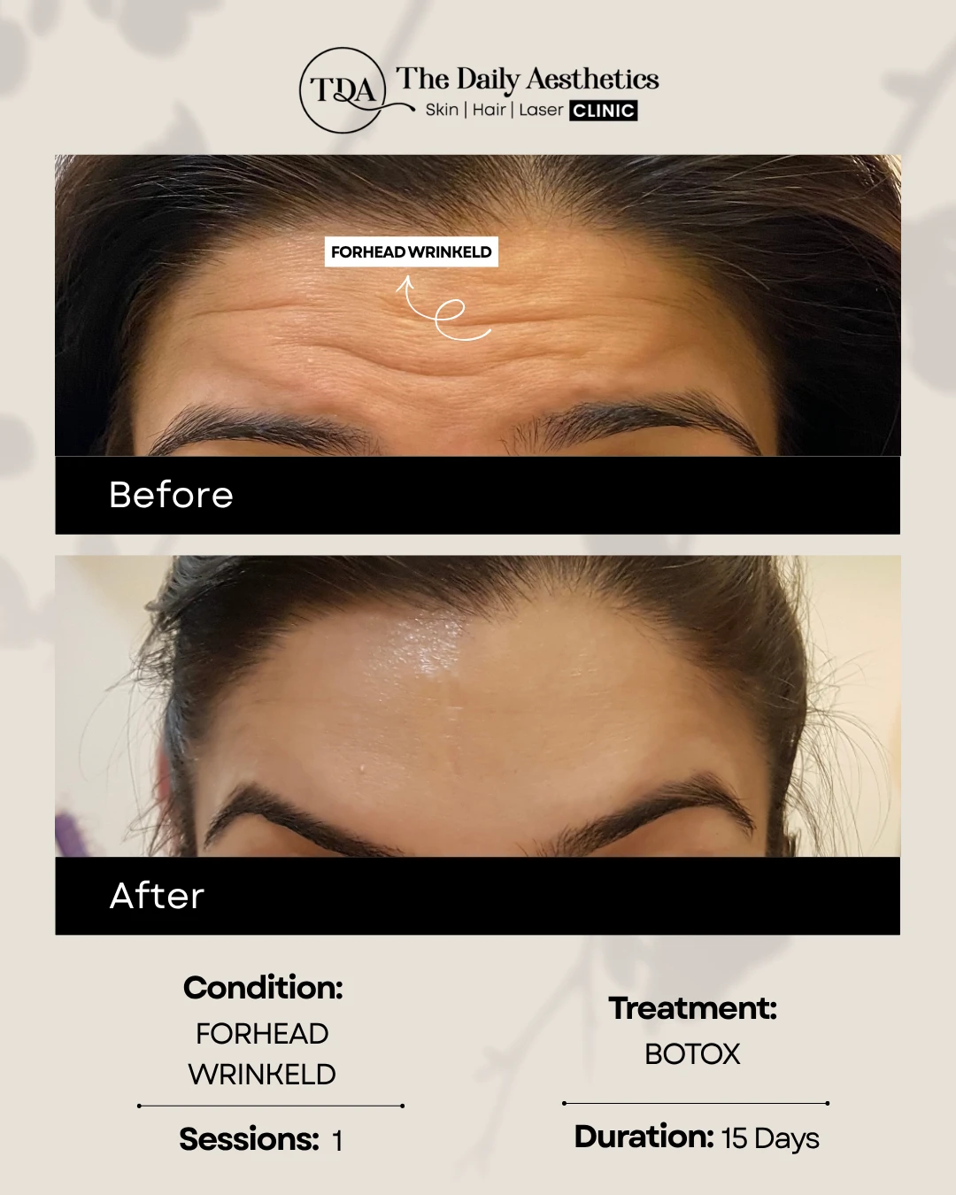 Forhead Wrinkled (Botox Treatment)
