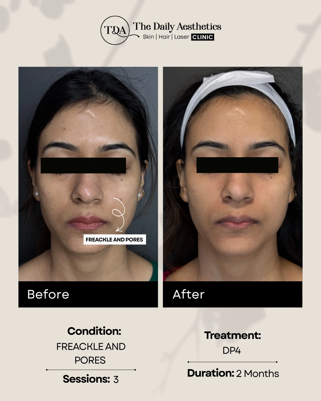 Frackle and Pores (DP4 Treatment)