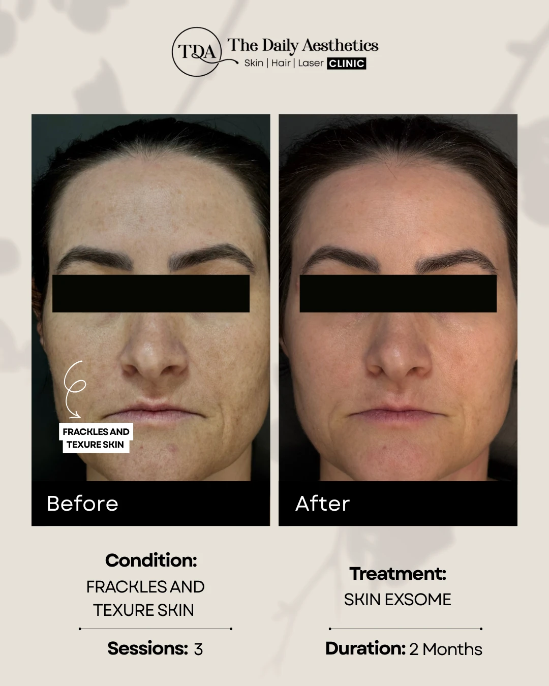 Frackles and Texure Skin (Skin Exsome Treatment)