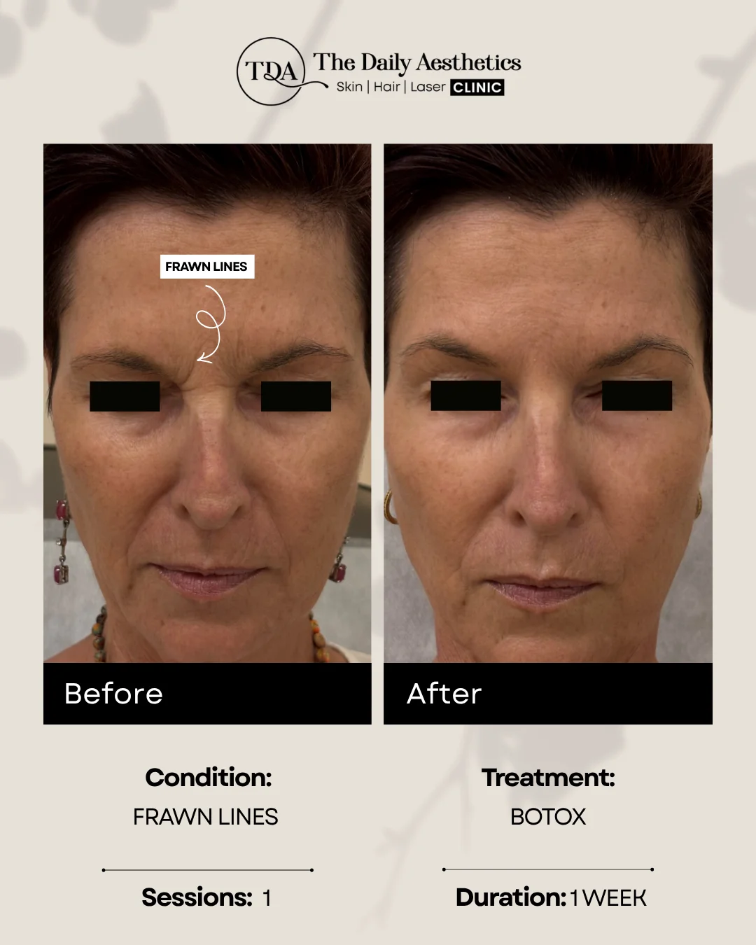 Frawn Lines (Botox Treatment)