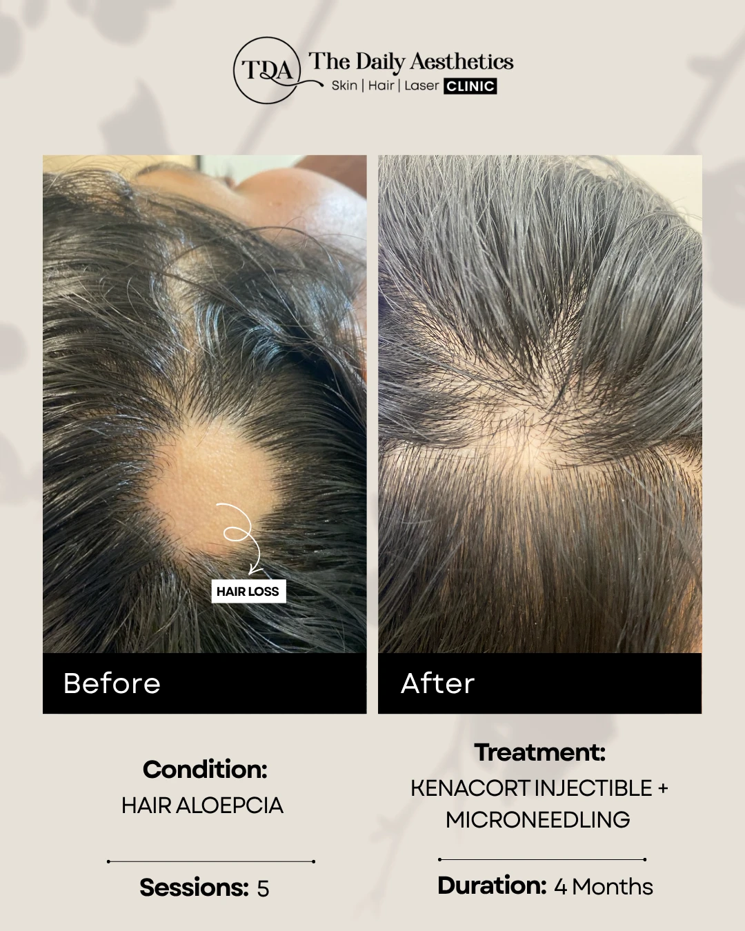 Hair Aloepcia (Kenacort Injectible + Microneedling Treatment) (2)