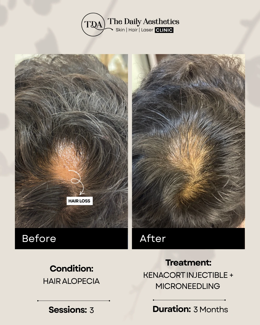 Hair Alopecia (Kenacort Injectible + Microneedling Treatment)