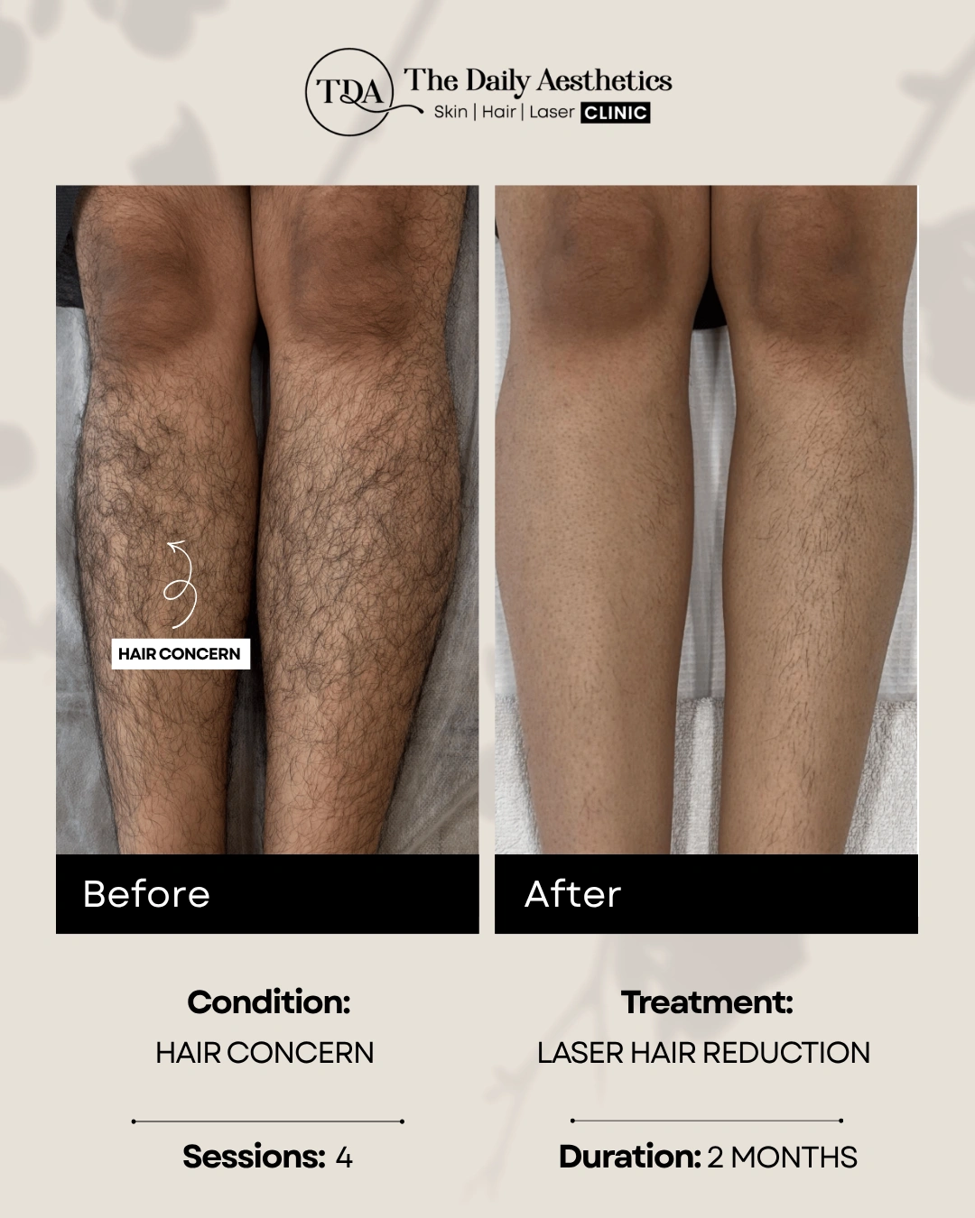 Hair Concern (Laser Hair Reduction Treatment)