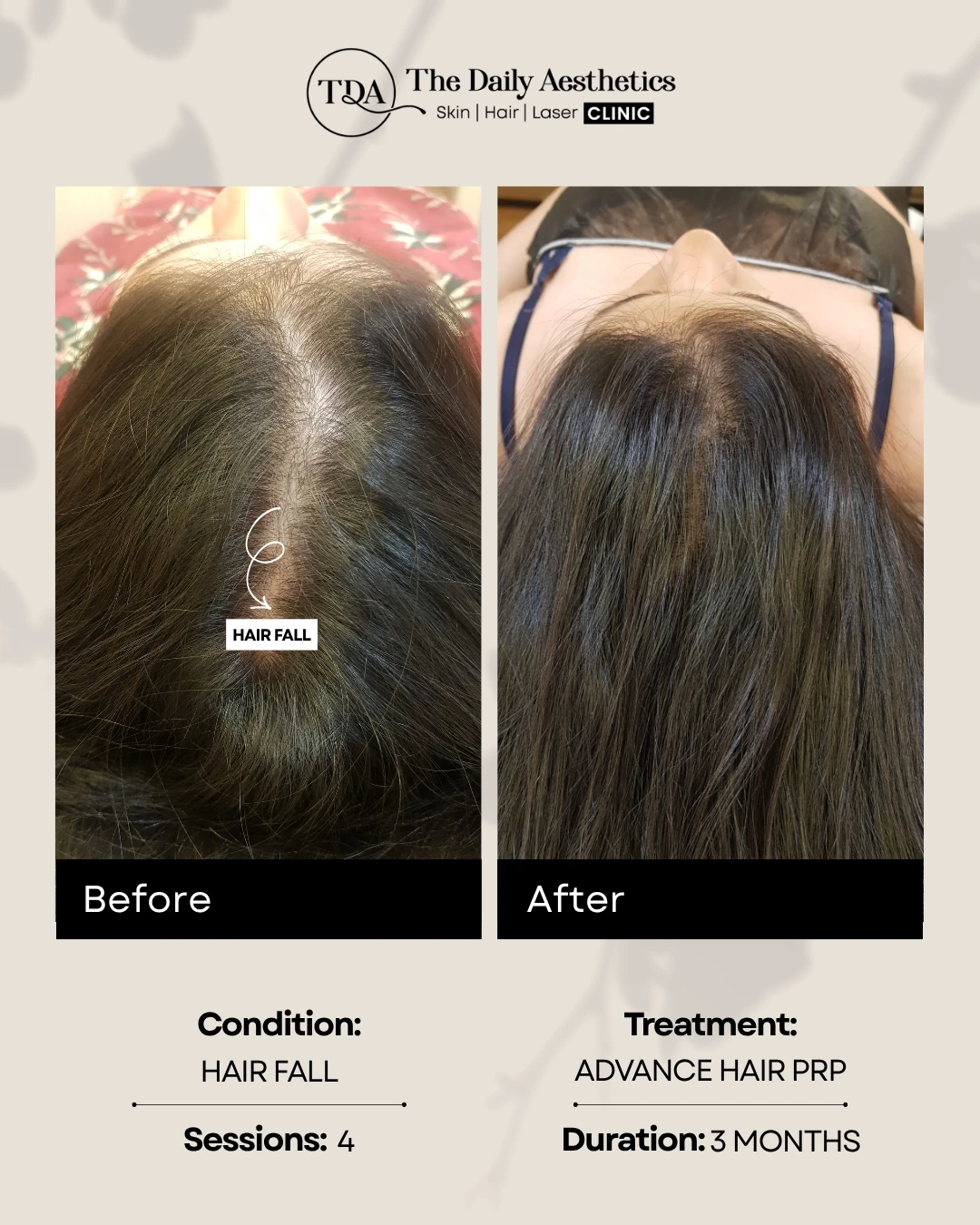 Hair Fall (Advance Hair PRP Treatment) (2)