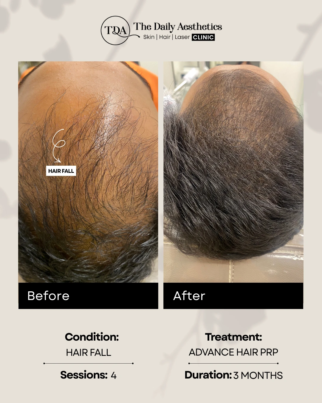 Hair Fall (Advance Hair PRP Treatment)