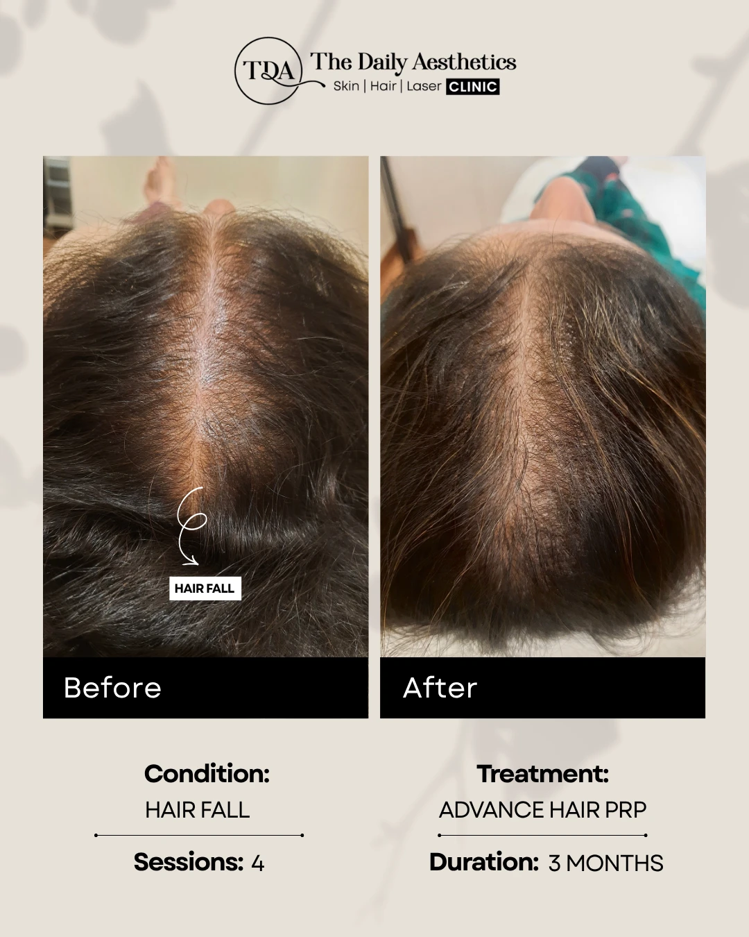 Hair Fall (Advanced Hair PRP Treatment)