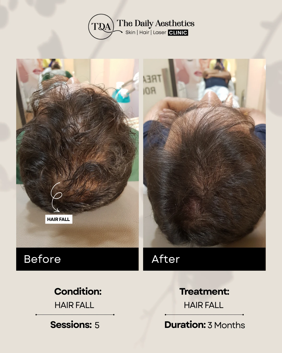 Hair Fall (Hair Fall Treatment)