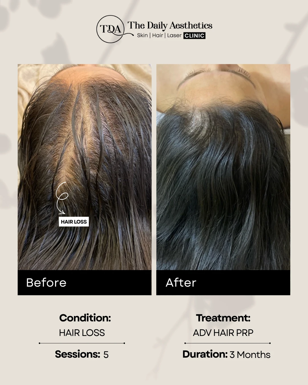 Hair Loss (ADV Hair PRP Treatment)