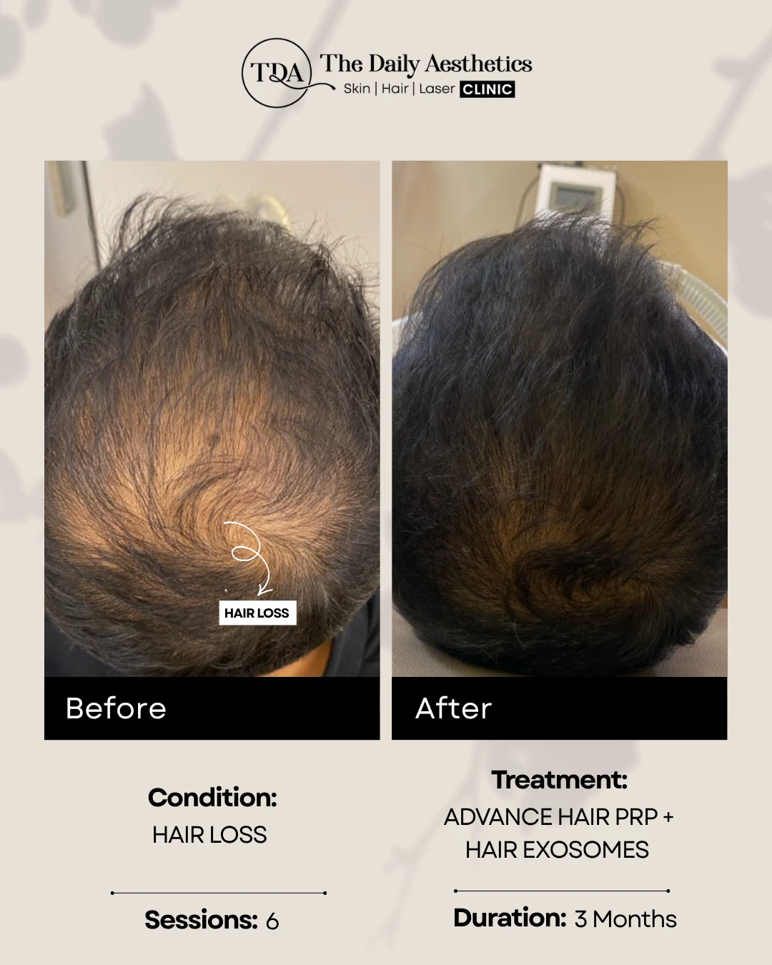 Hair Loss (Advance Hair PRP + Hair Exosomes)