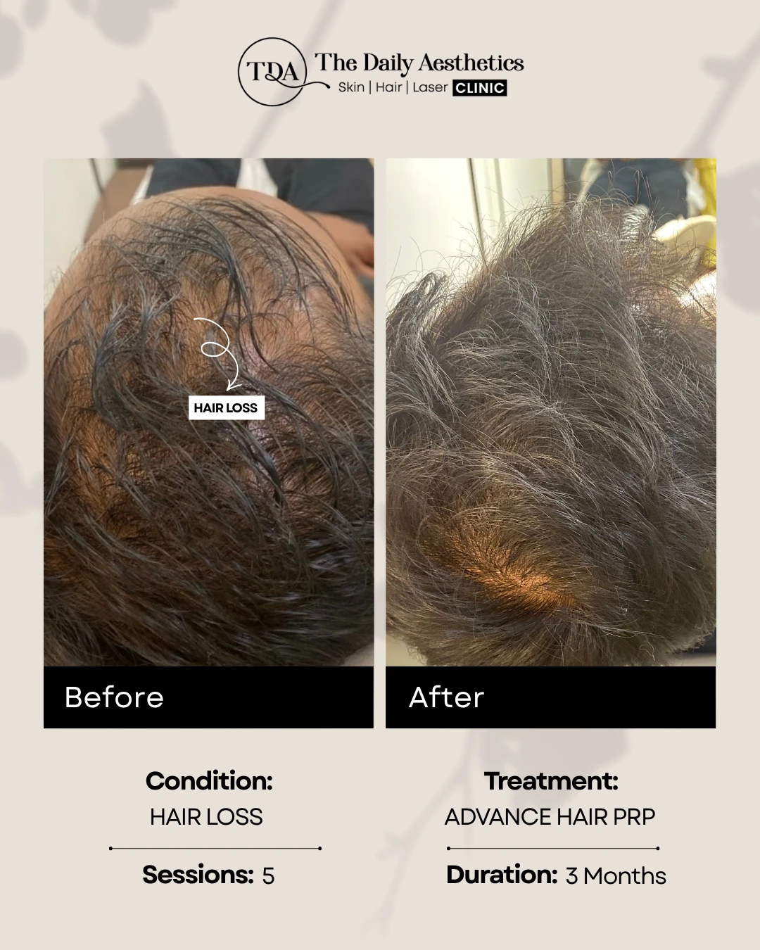 Hair Loss (Advance Hair PRP Treatment) (2)